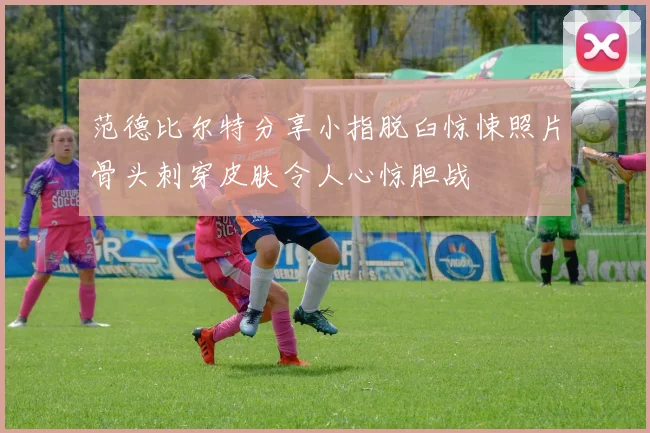 范德比尔特分享小指脱臼惊悚照片骨头刺穿皮肤令人心惊胆战